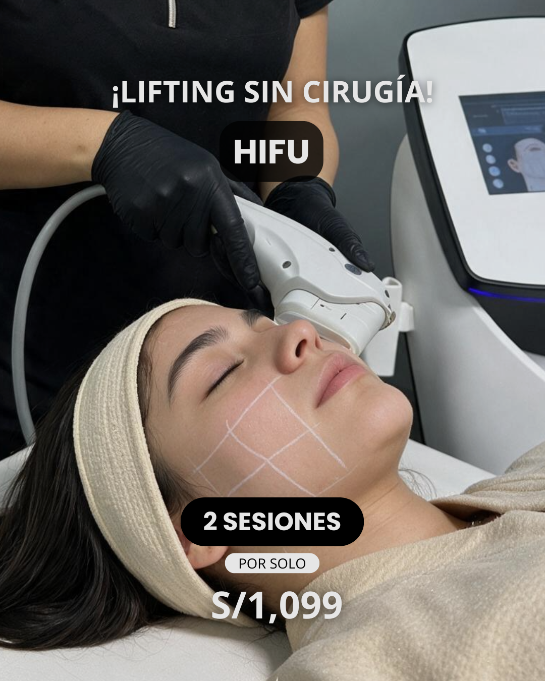 LIFTING SIN CIRUGÍA