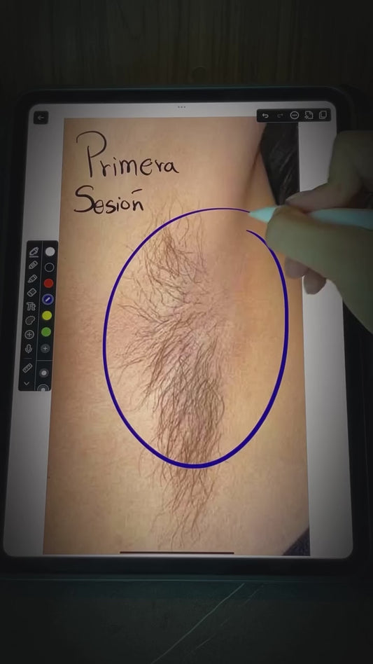 Depilación Laser - PAQUETES DE 8 SESIONES POR ZONA